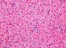 Ground_glass_hepatocytes_high_mag_2