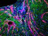 stroke cavity tissue research